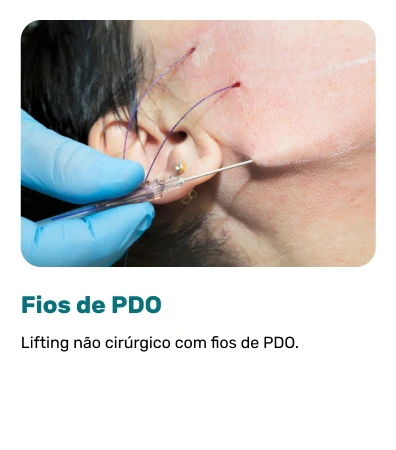 Fios-de-PDO.webp