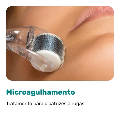 Microagulhamento.webp