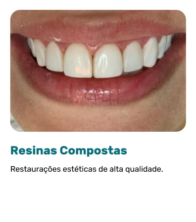 Resinas-Compostas.webp